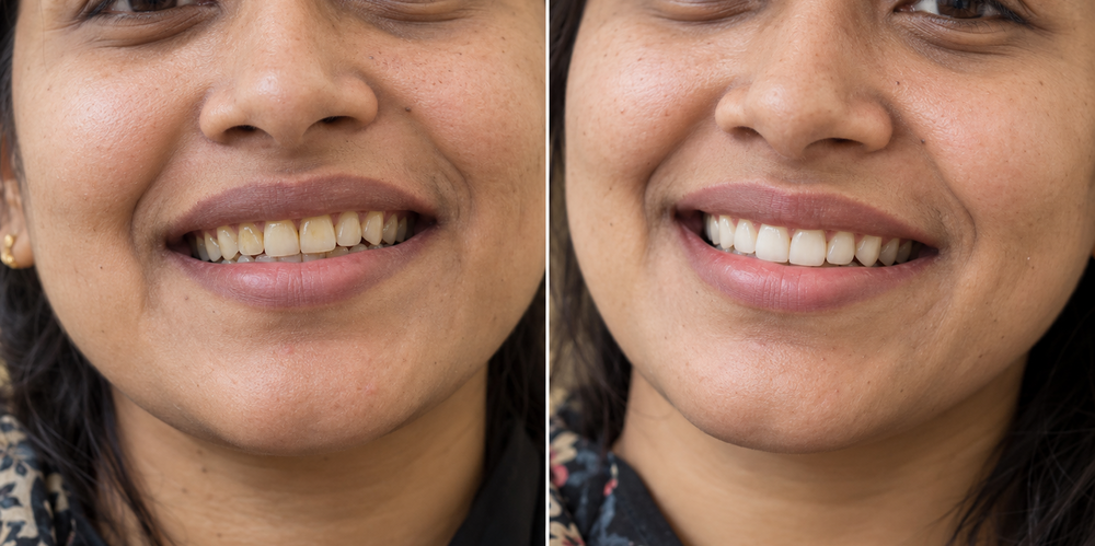 Illustrative before and after teeth whitening image